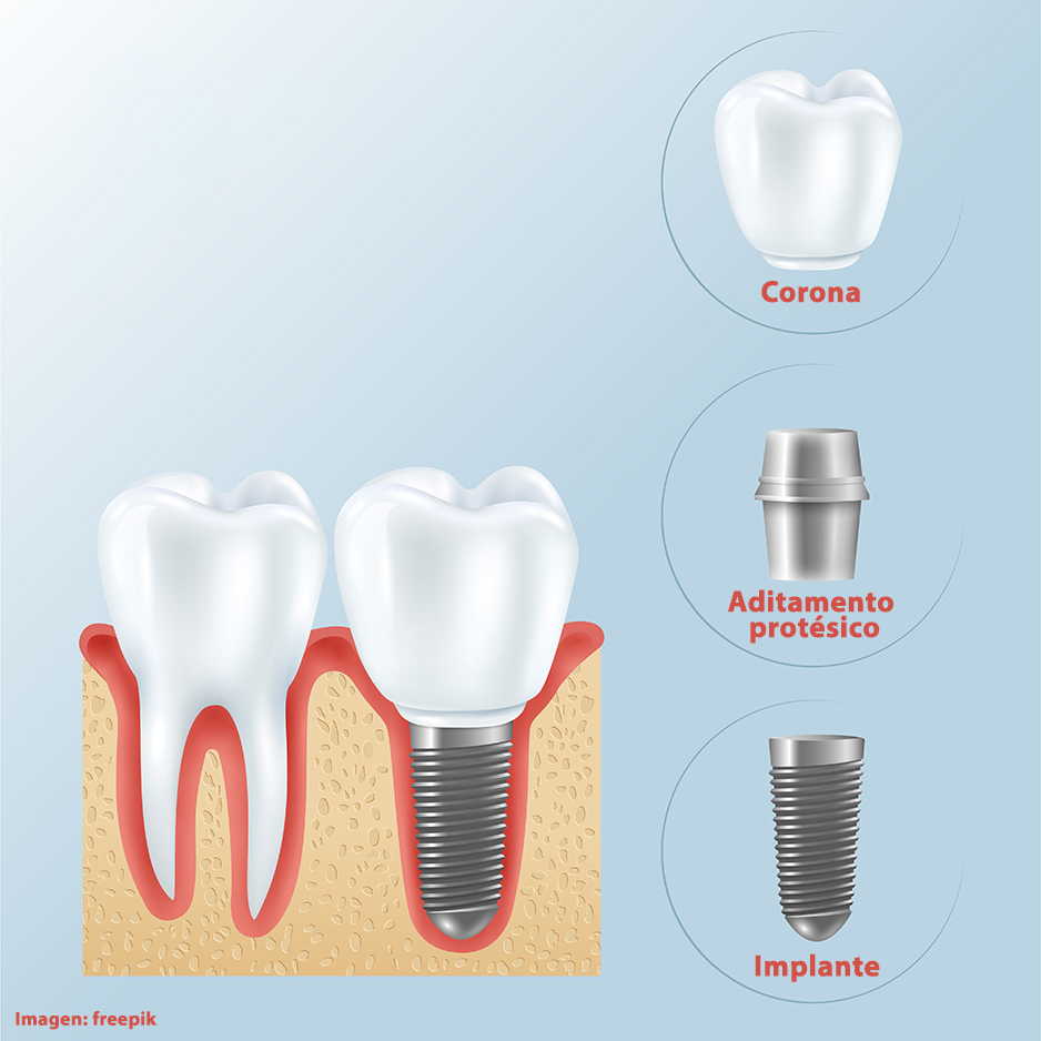 Tipos de implantes dentales