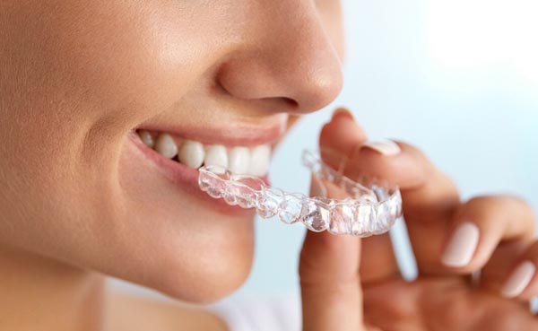 Alienadores dentales