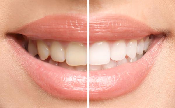 Blanqueamiento dental