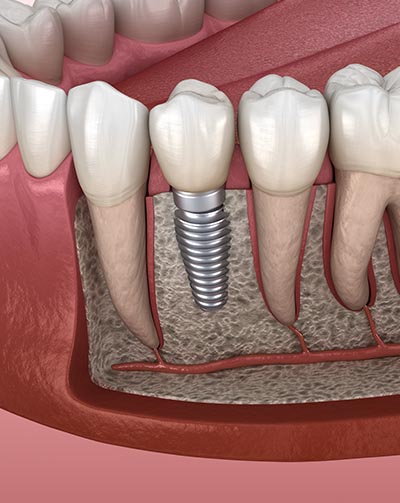 Clinica implante dental en fraga