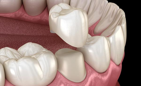 Corona dental de porcelana