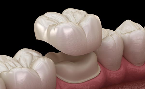 Corona dental de zirconio