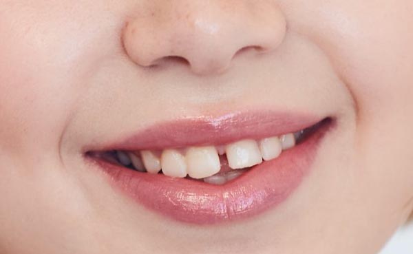 Corregir diastemas dentales