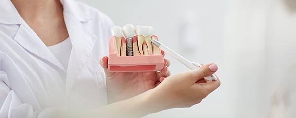 Especialistas en implantes dentales en Fraga