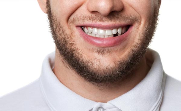 Recuperar un diente que falta