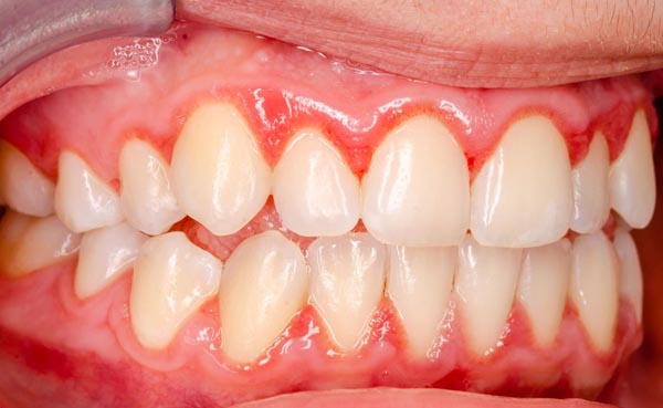 Gingivitis