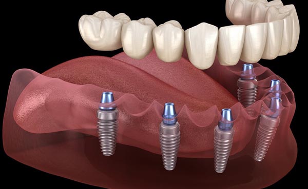 Implantes de carga inmediata en Fraga