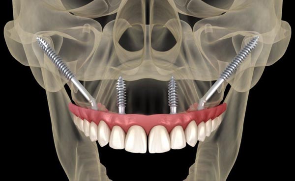 Implantes cigomaticos
