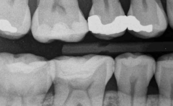Periodontitis