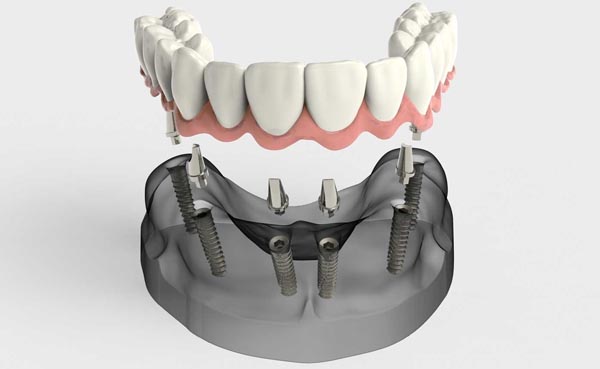 Protesis dental fija sobre implantes