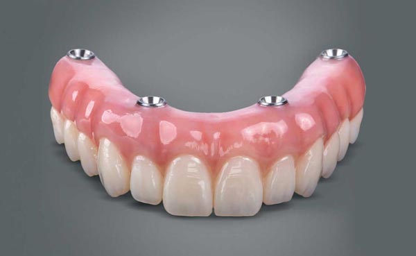 Protesis dental removible sobre implantes