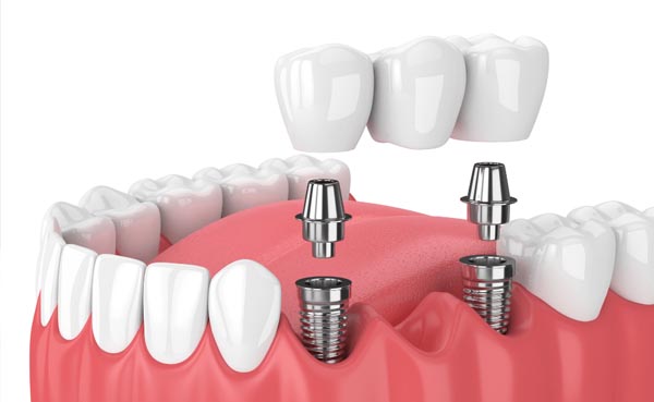 Puente dental sobre implantes