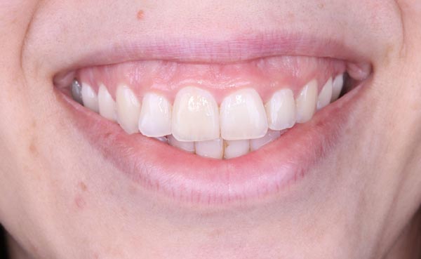 Sonrisa gingival