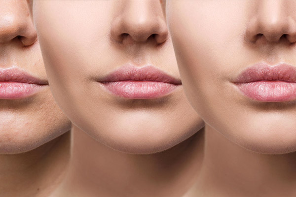 Aumento de labios en fraga