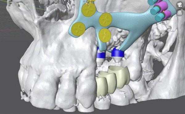 Implantes subperiosticos