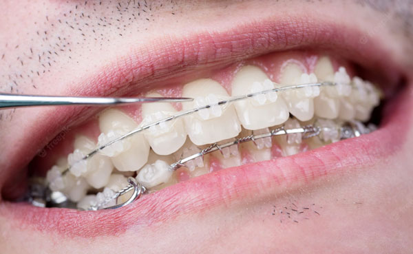 Brackets esteticos en Fraga