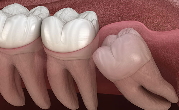 Cirug&iacute;a de cordales impactados y muelas del juicio