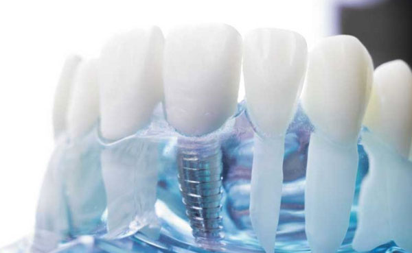 Cirug&iacute;a de implantes en tarrega