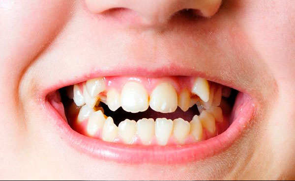 Cirug&iacute;a de fenestraci&oacute;n de caninos