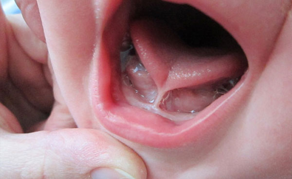 Cirugia frenillo lingual