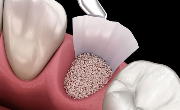 Cirug&iacute;a de injerto de hueso