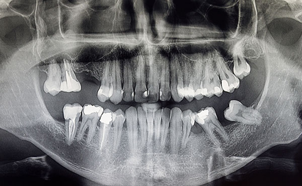Cirugia maxilofacial