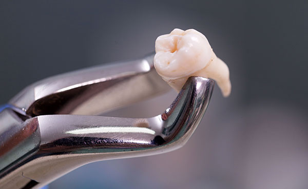 Extraccion dental fraga