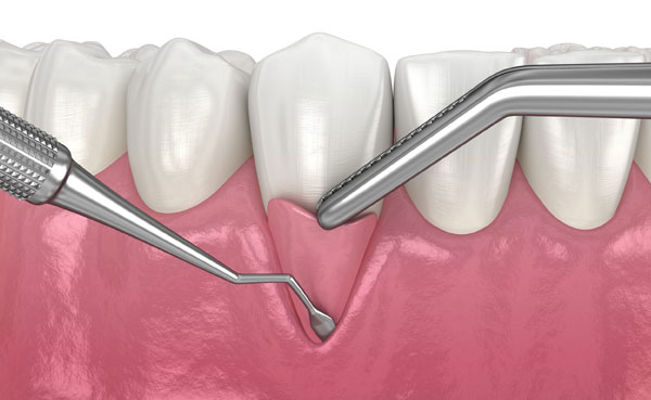 Injerto de encias fraga