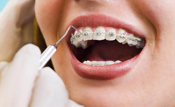 Ortodoncia brackets metalicos