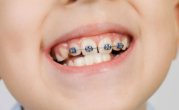ortodoncia infantil