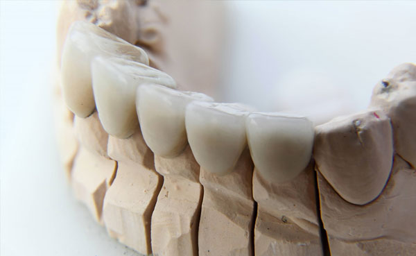 Protesis dental fija