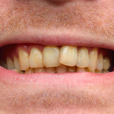 blanqueamiento manchas extrinsecas exogenas