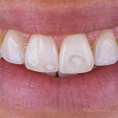 Blanqueamiento dental de manchas intrinsicas