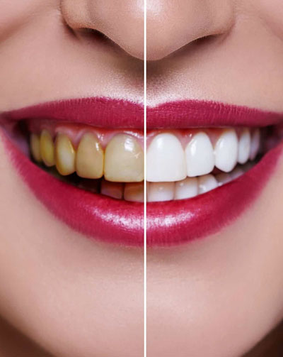 Mejor blanqueamiento dental en fraga