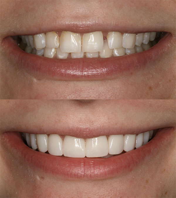ejemplo de antes y despu&eacute;s de carillas dentales