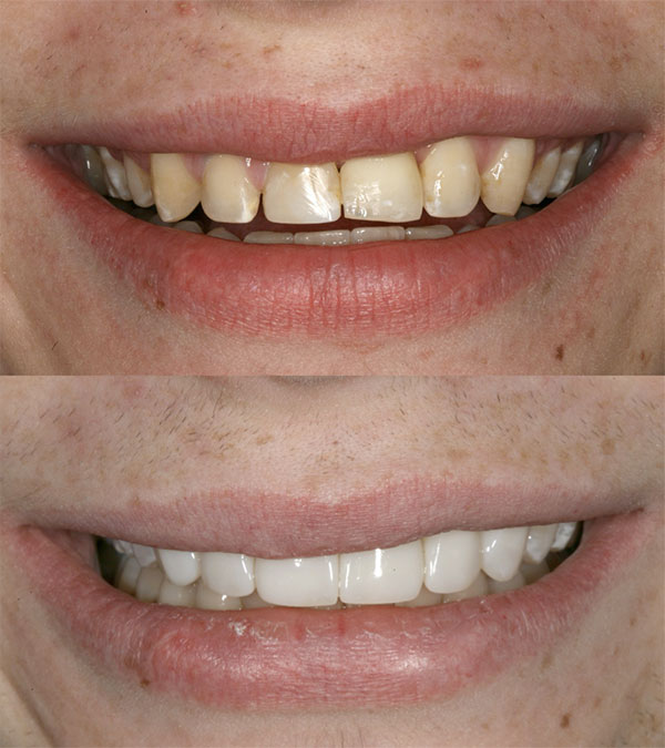 Ejemplo antes y despues de carillas dentales