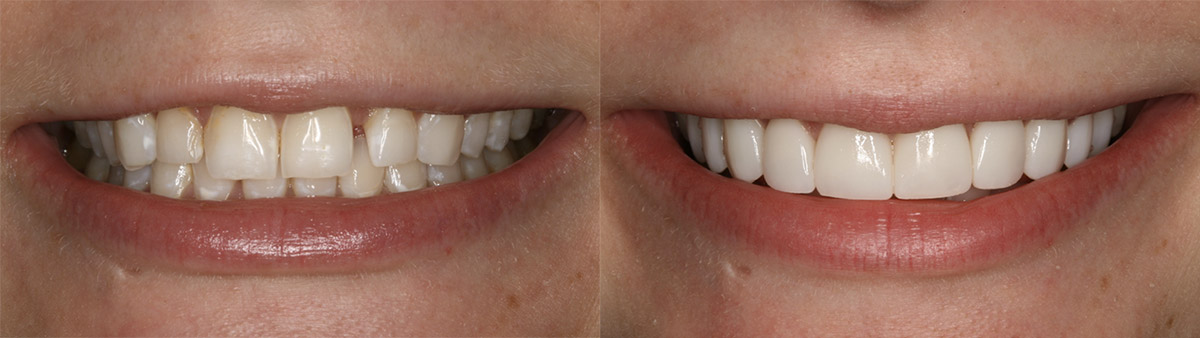 Especialistas en carillas dentales en fraga