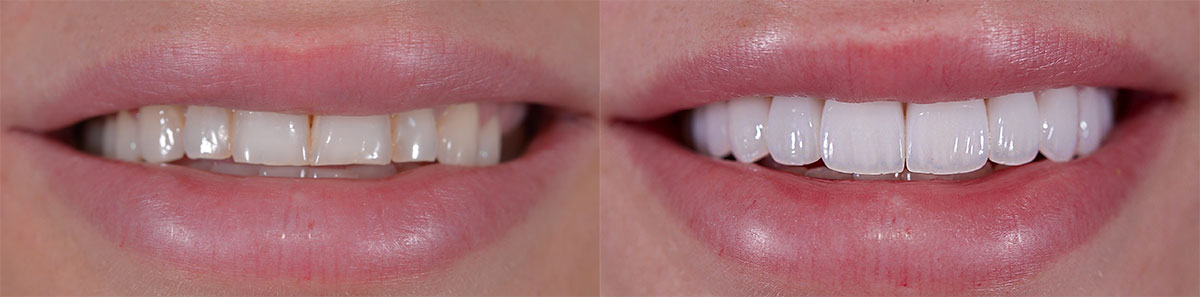 Otro ejemplo de carillas dentales antes y desues