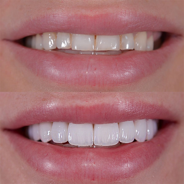 Antes y. despues carillas dentales