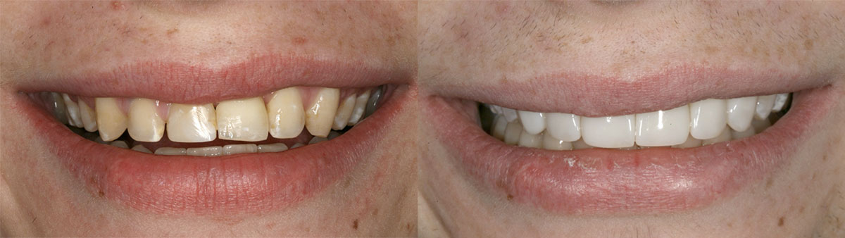 Ejemplo de carillas dentales