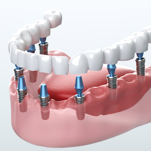 Implantes dentales para personas mayores de 60 a&ntilde;os